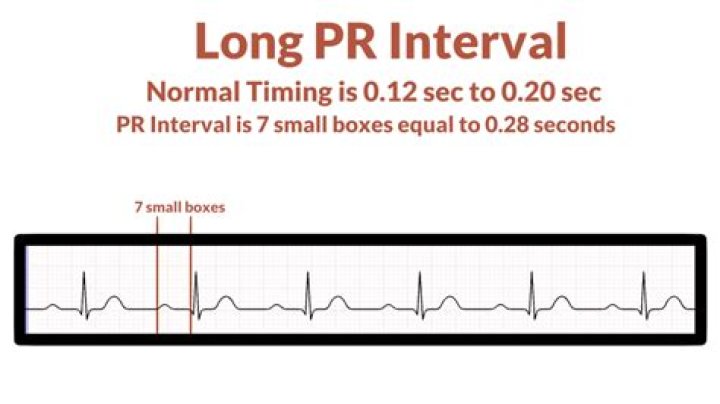 Is a prolonged PR interval dangerous?