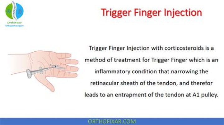What is the CPT code for trigger finger release?